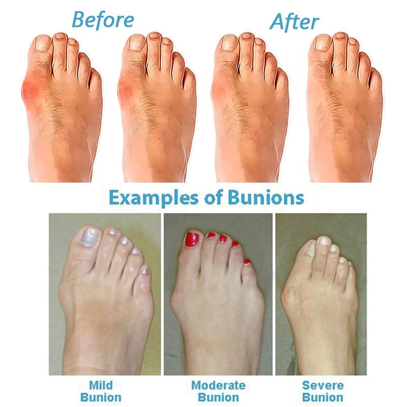 ORTHOSOLE SANDALS - Hallux Valgus sandals for pain-free walking