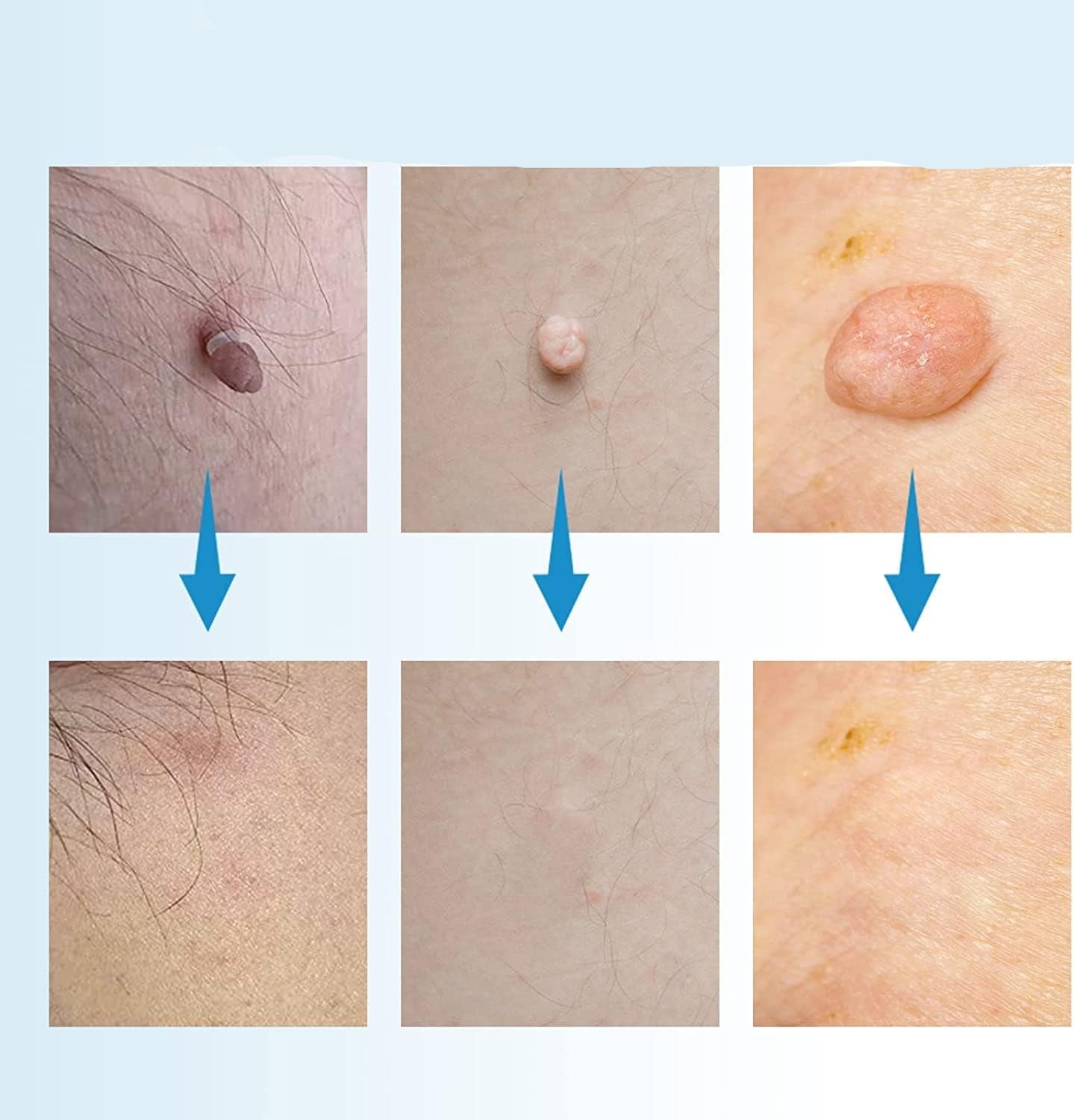 SpotOff Skin Tag Remover - Painless skin tag removal for neck, back & body