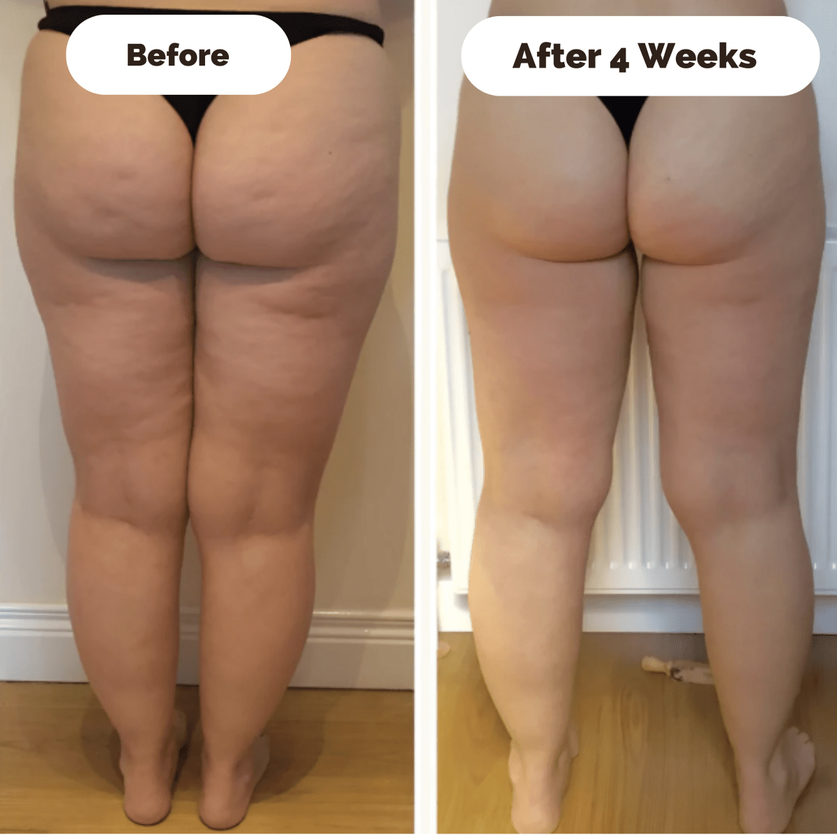 SKINLIFT – Appareil de massage raffermissant contre la cellulite