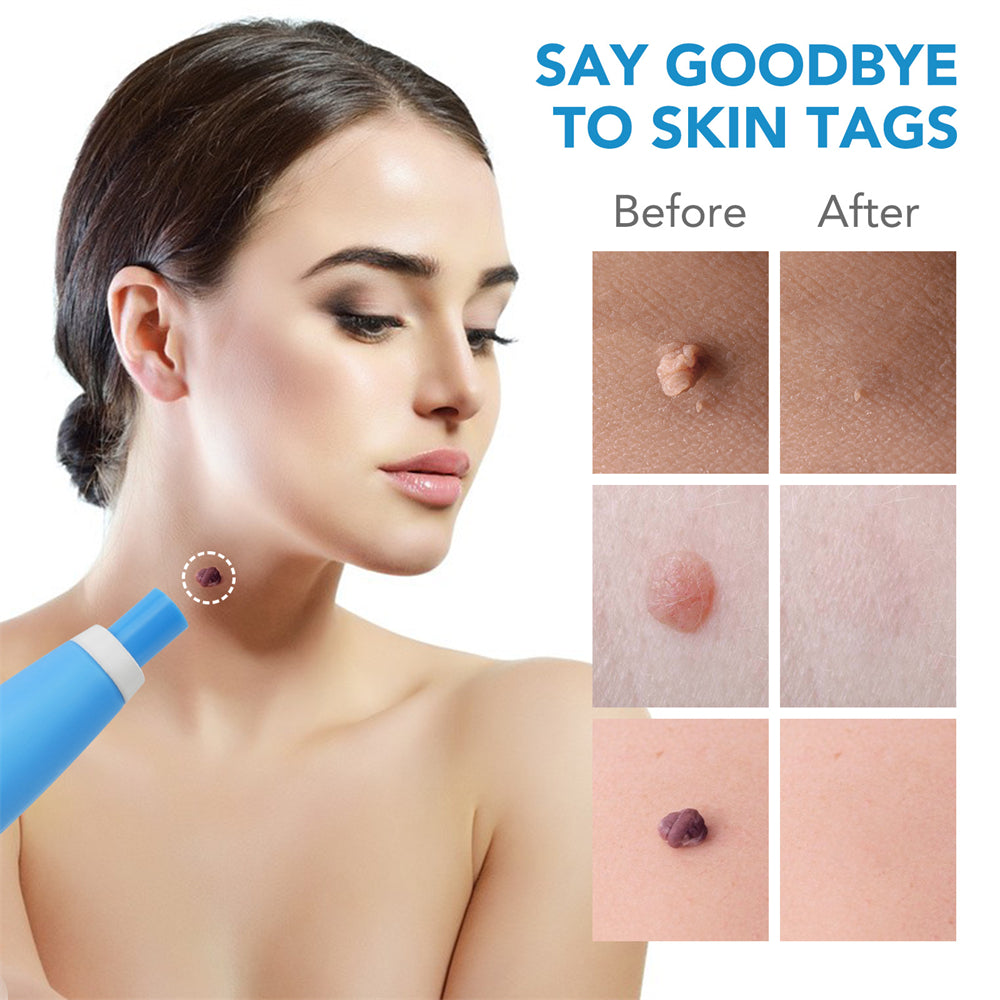 SpotOff Skin Tag Remover - Painless skin tag removal for neck, back & body