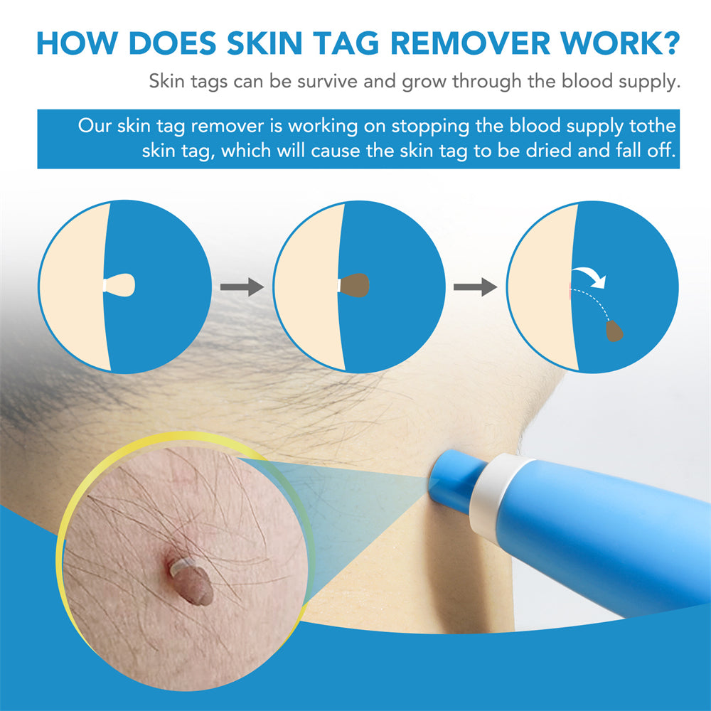 SpotOff Skin Tag Remover - Painless skin tag removal for neck, back & body