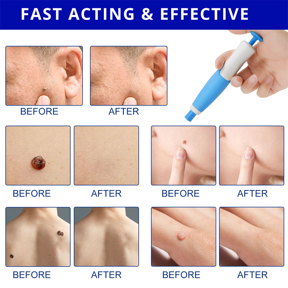 SpotOff Skin Tag Remover - Painless skin tag removal for neck, back & body