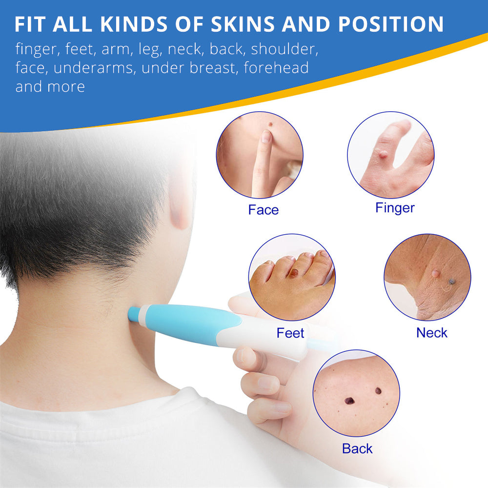 SpotOff Skin Tag Remover - Painless skin tag removal for neck, back & body