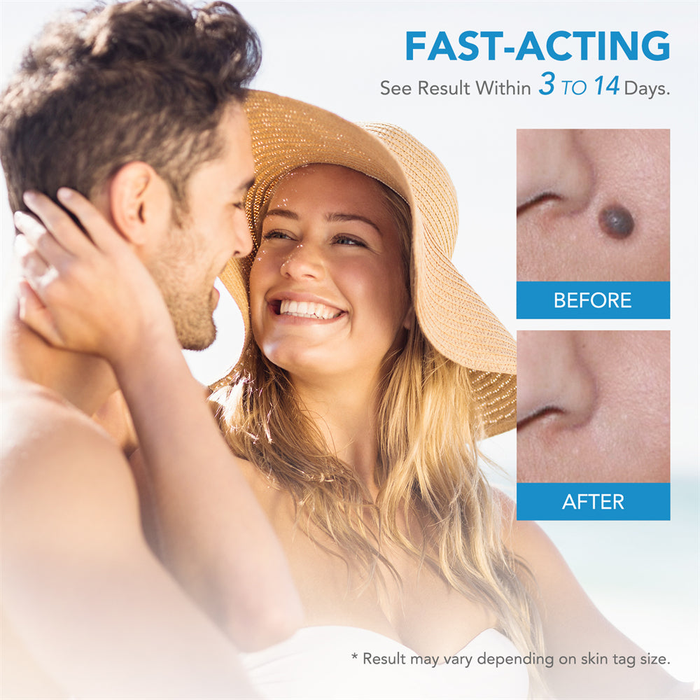 SpotOff Skin Tag Remover - Painless skin tag removal for neck, back & body