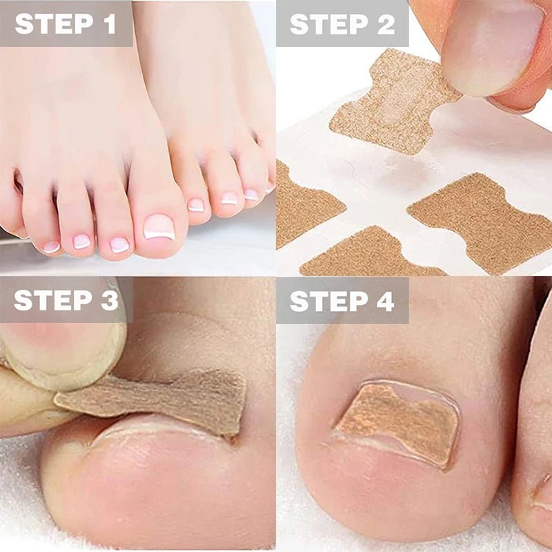 FixaNail – Gentle Nail Correction for Ingrown Nails & Pain