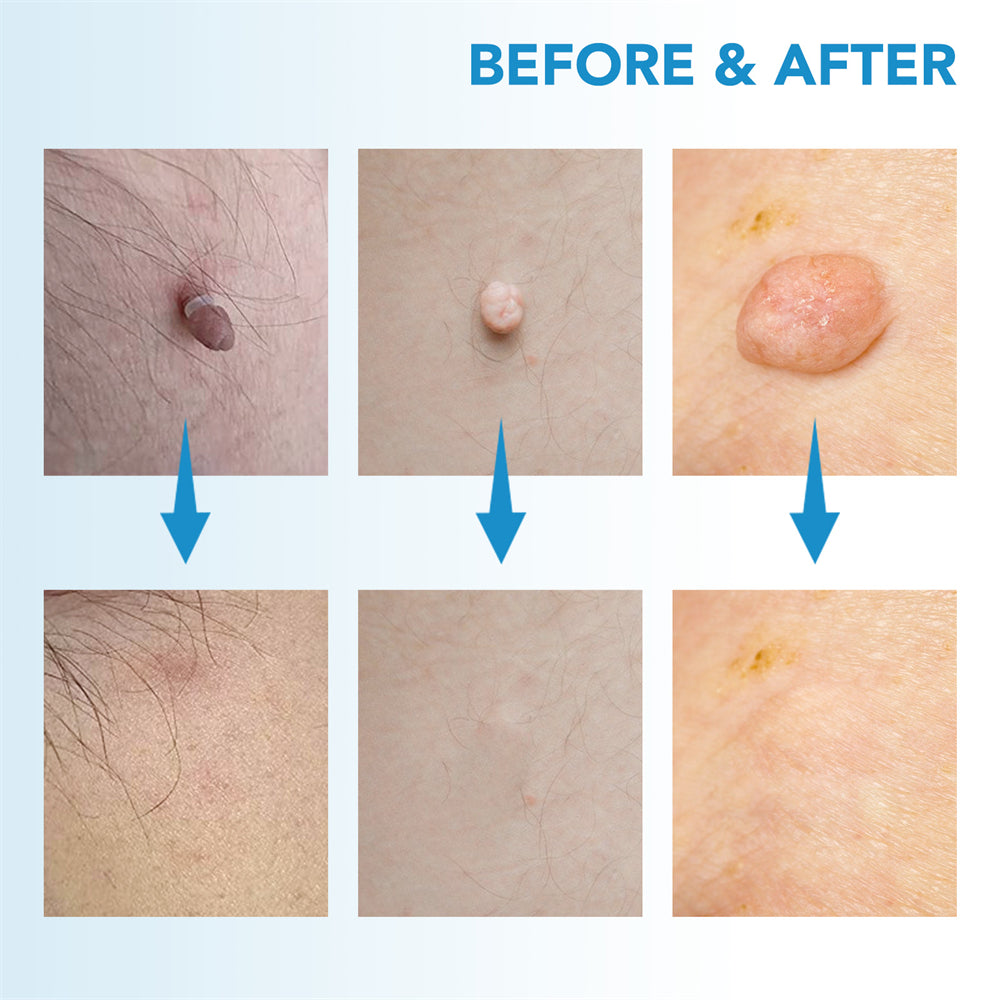 SpotOff Skin Tag Remover - Painless skin tag removal for neck, back & body
