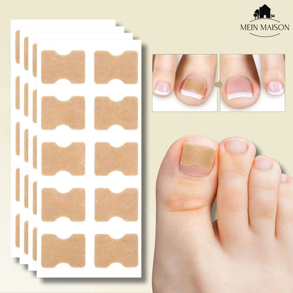 FixaNail – Corrección suave de uñas contra uñas encarnadas y dolor