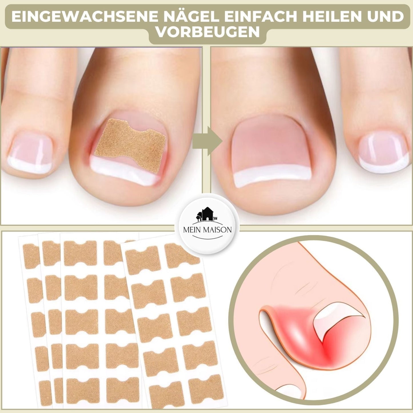 FixaNail – Corrección suave de uñas contra uñas encarnadas y dolor