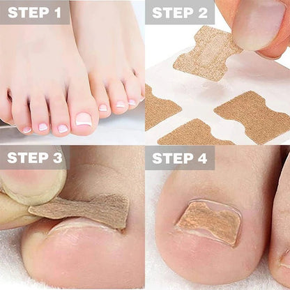 FixaNail - Correction en douceur des ongles incarnés et des douleurs