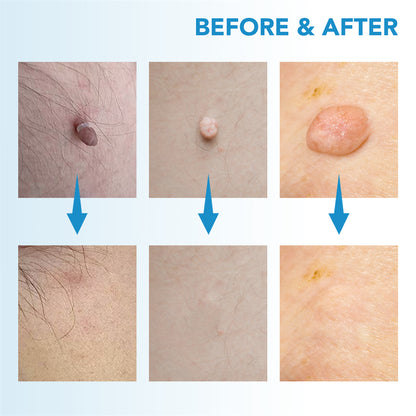 SpotOff Skin Tag Remover - Painless skin tag removal for neck, back & body